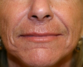 Feel Beautiful - Filler in Nasal Labial Folds-Creases San Diego - Before Photo